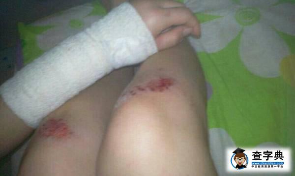 香港女星被狗狗咬到手穿孔 手腫變“豬蹄”2